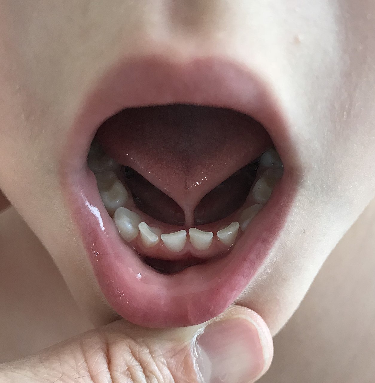 Chirurgie des freins de langue MaxilloFacial privé SaintEtienne