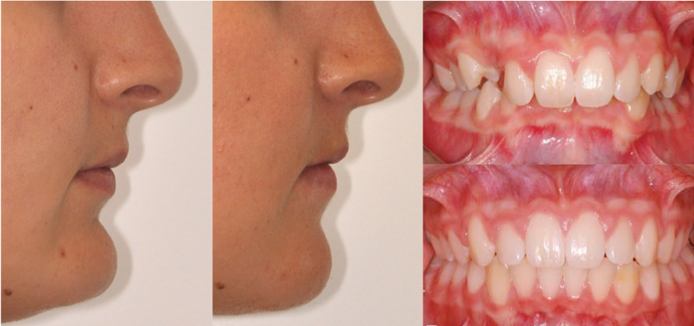 ostéotomie maxillo-mandibulaire et génioplastie